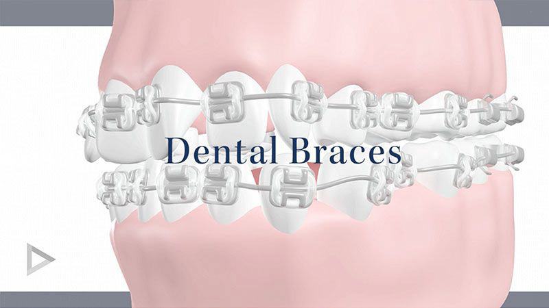 Braces Orthodontist In Thornton Co